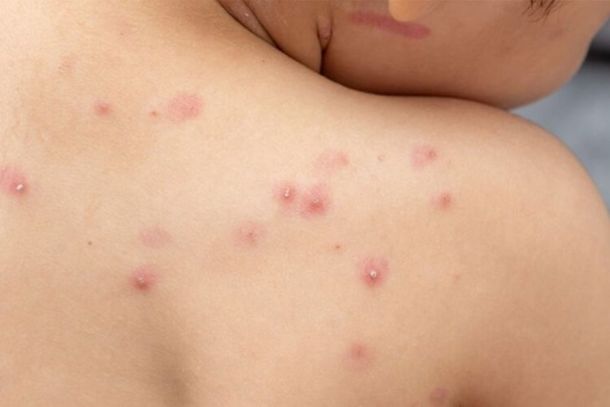 Aumentam os casos de varíola investigados em SC