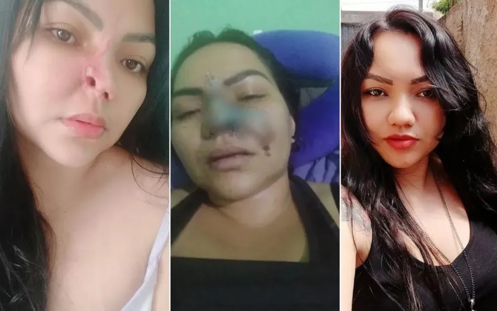 <strong>Dentista é indiciado após paciente perder parte do nariz em Goiás</strong>